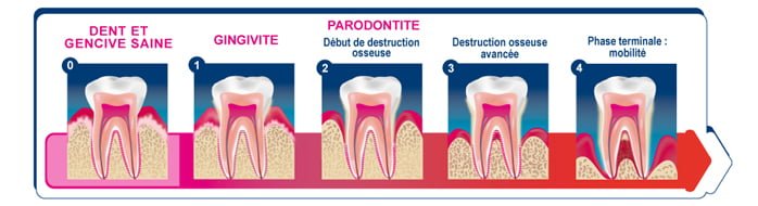 Etapes d'avancement de la gingivite vers la parodontite, traitement et prévention à Constantine en Algérie