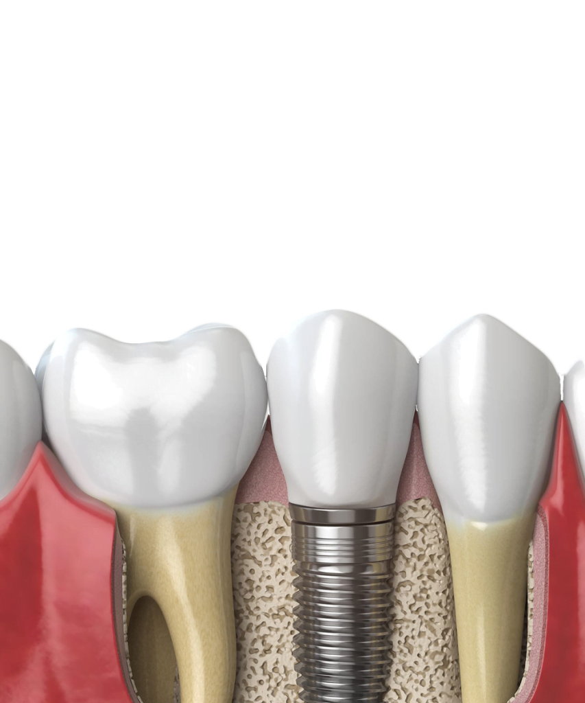 Image of a Dental implant, tooth implant