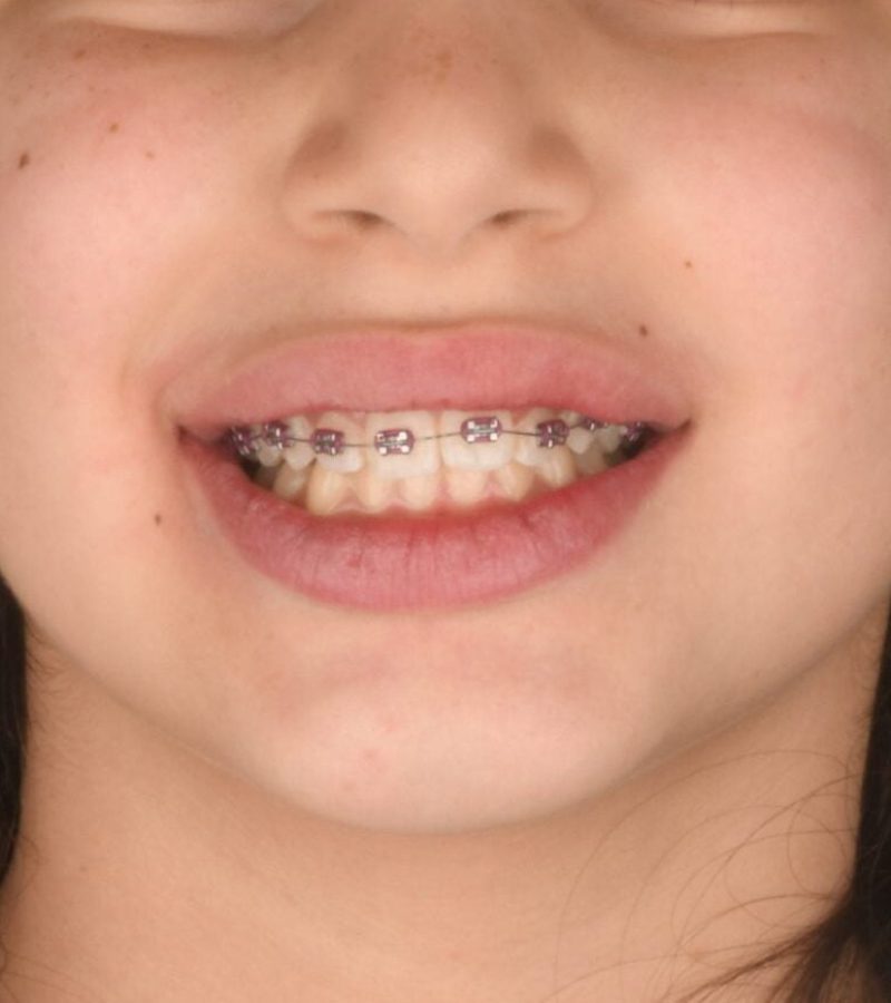 A child wearing orthodontic dental braces in Algeria, Dental clinic in Algeria, Constantine
