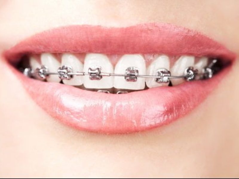 metalic orthodontic teeth braces
