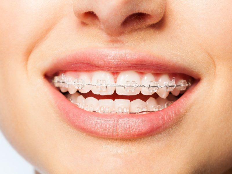 Dents avec Appareil dentaire ODF à Constantine en Algérie aligner ses dents avec un appareil dentaire ODF en céramique, bagues dentaires en céramique, appareil dentaire bague transparente