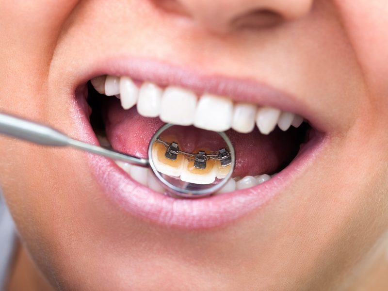 Dents avec Appareil dentaire ODF interne à Constantine en Algérie aligner ses dents avec un appareil dentaire ODF interne, bagues dentaires odf internes, appareil dentaire bague internes