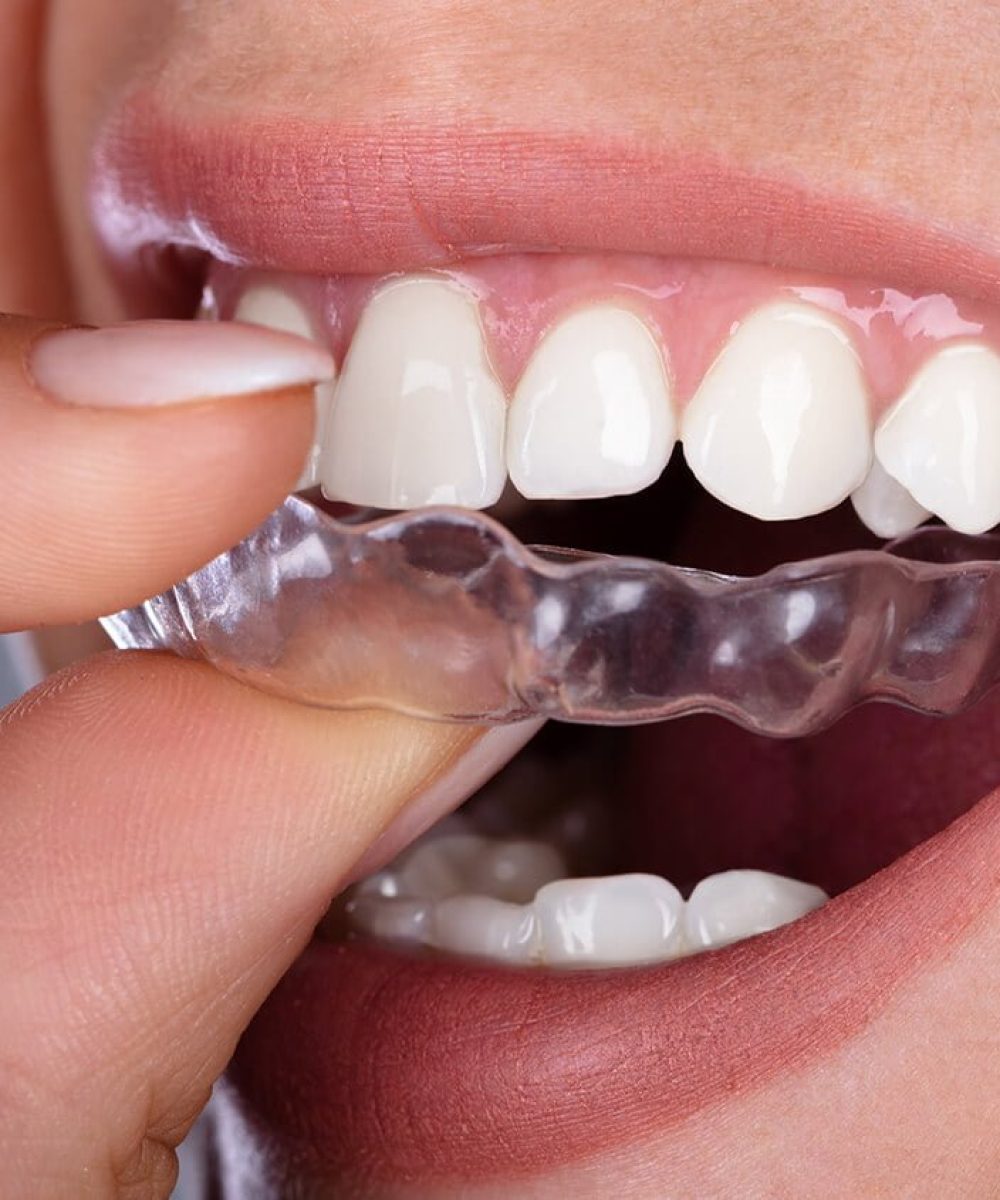 woman wearing clear aligners (invisalign and smilers) to straighten her teeth