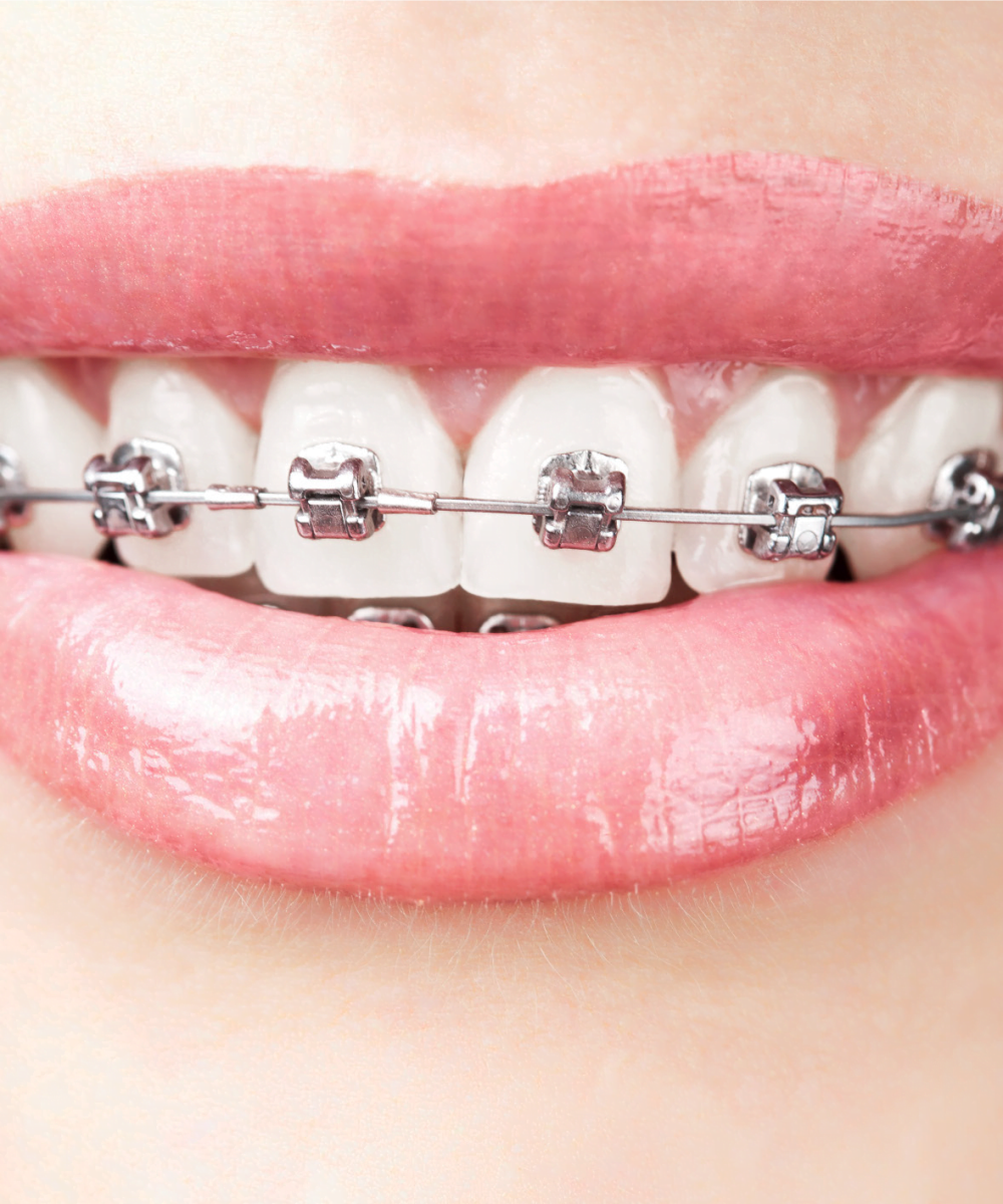 Woman mouth after metalic orthodontic dental braces in Algeria