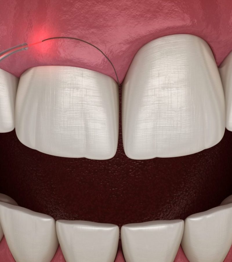 Utilisation du laser dentaire en Algérie à Constantine pour le Blanchiment, sourire gingival, soins dentaires et autres chirurgies dentaires