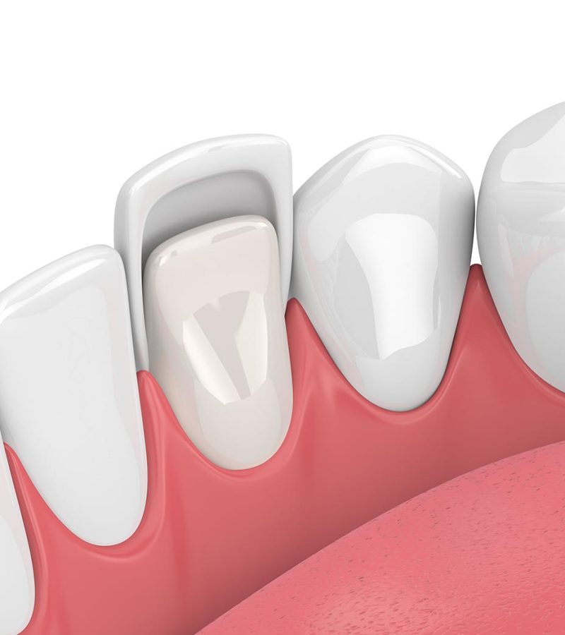 Dental veneers illustration, a veneer covering a tooth