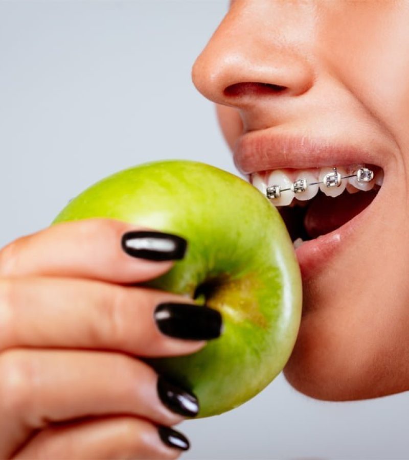 Femme portant un appareil dentaire odf métallique entrain de croquer une pomme