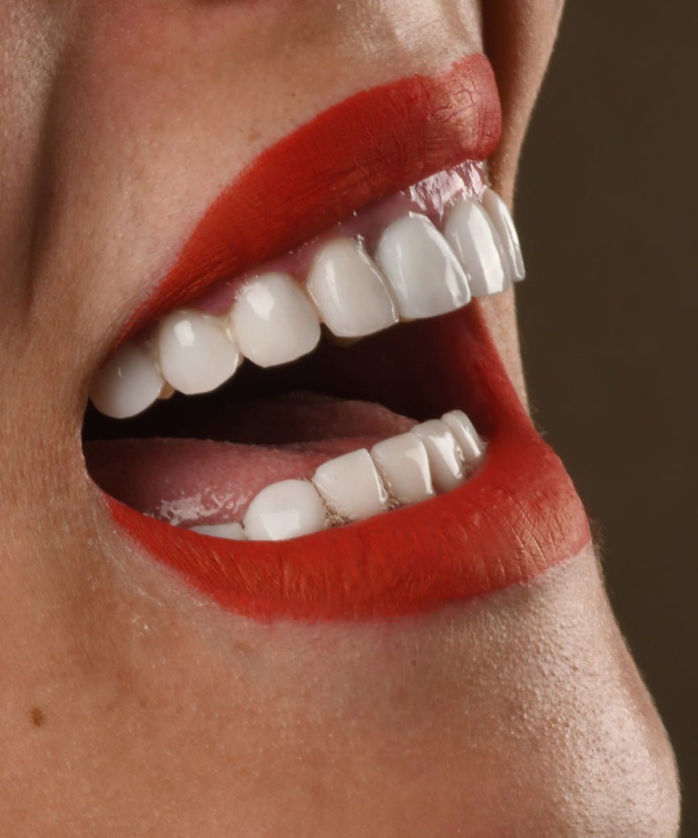 Hollywood smile à Constantine en Algérie, Dents de femme avec hollywood smile et pose de facettes dentaires ainsi qu'un blanchiment dentaire