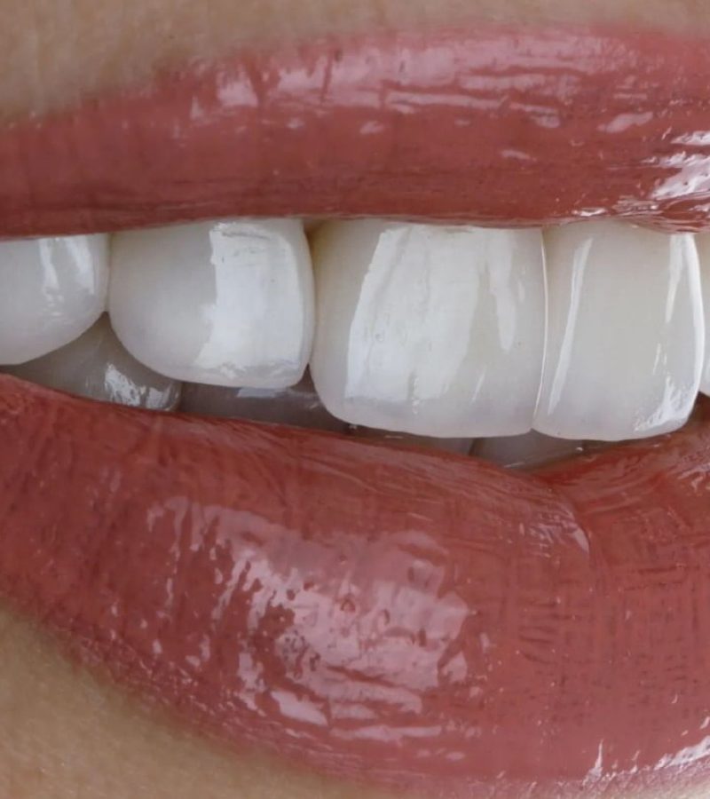 Femme portant des facettes dentaires en Zircone en Algérie, sourire blanc éclatant, correction de forme des dents
