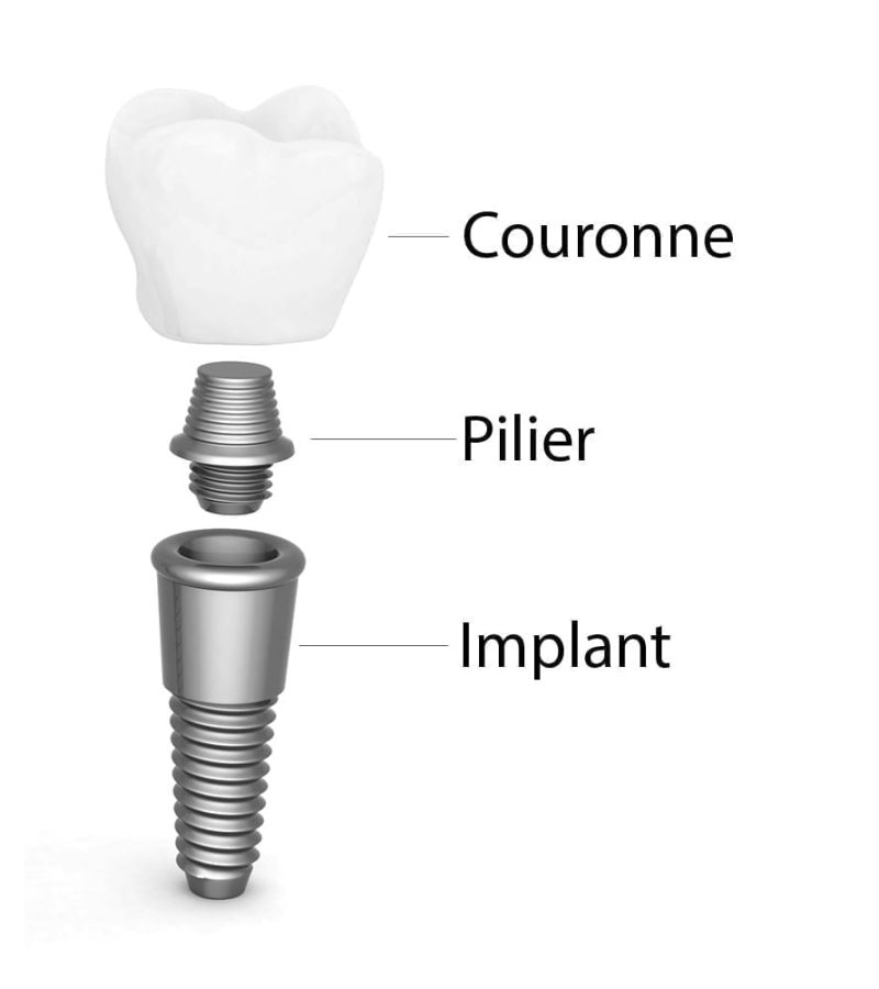 C'est quoi un implant dentaire, parties d'un implant dentaire, couronne dentaire, pilier, et implant dentaire