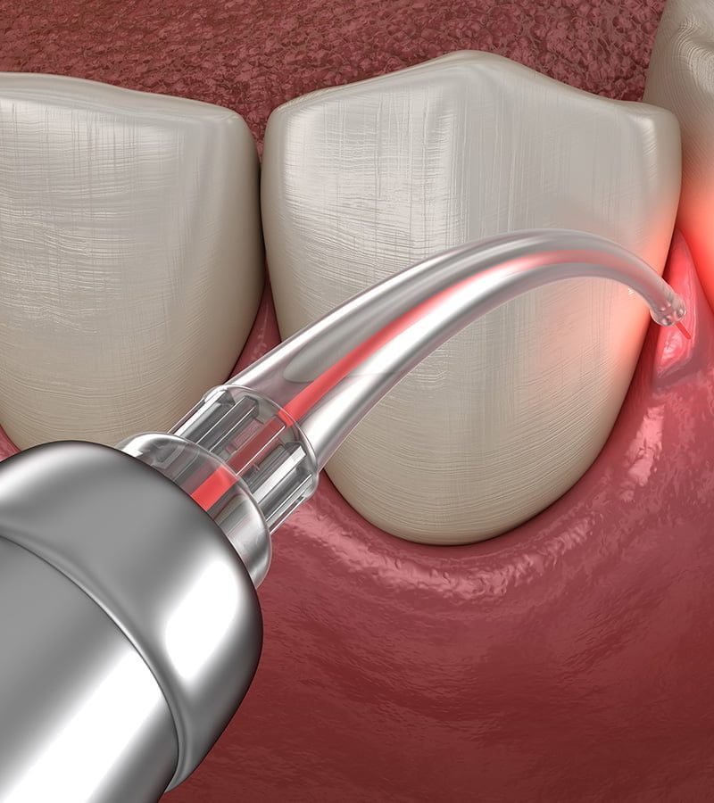 laser dentistry used for treatment of gum, gummy smiles, teeth whitening and other types of dental surgeries
