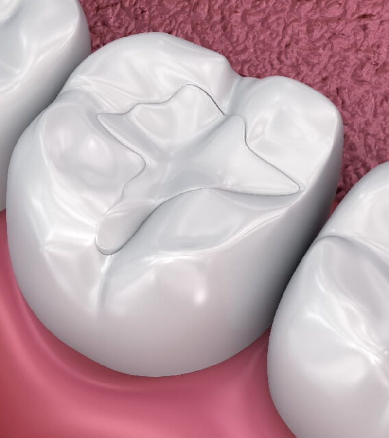 dental filling treatment or tooth decay and cavities